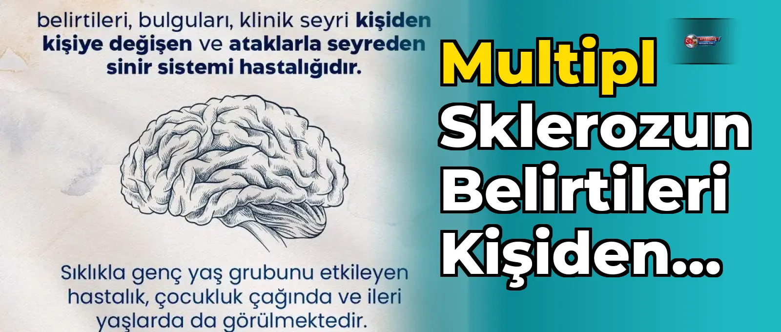 Multipl sklerozun belirtileri kişiden kişiye farklılık gösteriyor
